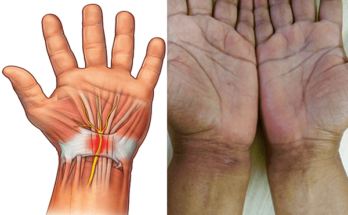 Carpal Tunnel Release Surgery